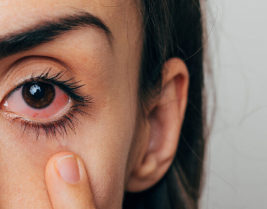 eye flu symptoms