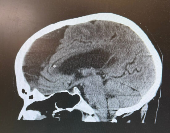 Peer-Reviewed Study Sheds Light on Personality Changes After Covid Shots
